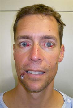 Adam Parer five days after the hang glider accident. The haemotoma in his eyes is beginning to heal.