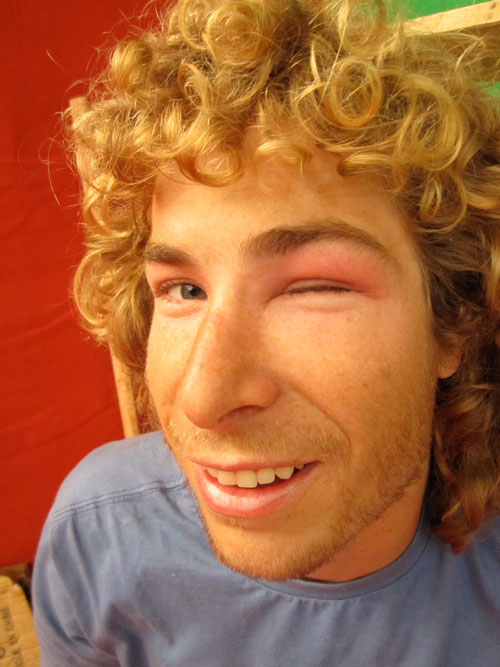 An antic... Ant Green, XCmag's resident acro pilot, suffers extreme eye reaction to a bee sting